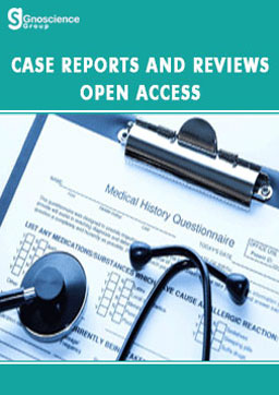 Klinefelter Syndrome in an Identical Twin: A Case Report and Review of Literature