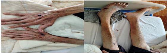 An Extensive Atypical Systemic Light Chain Amyloidosis With Undetectable Plasma Cell Dyscrasia: A Case Report